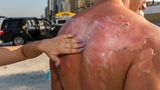 Sonnenverbrannter Rücken eines jungen Mannes wird eingecremt