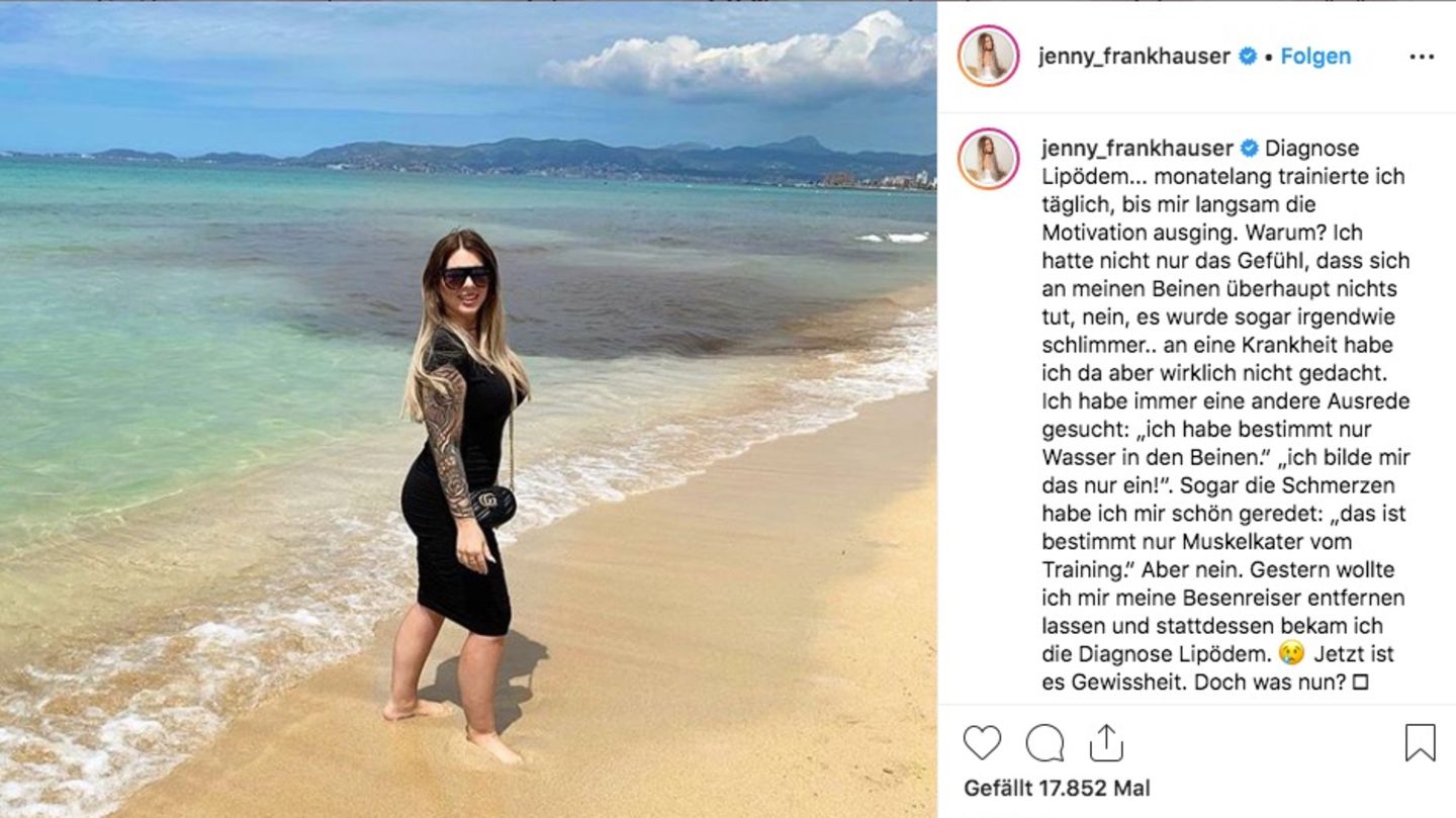 Jenny Frankhauser leidet unter der Krankheit Lipödem