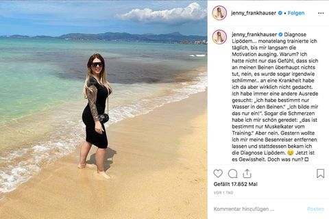 Jenny Frankhauser leidet unter der Krankheit Lipödem