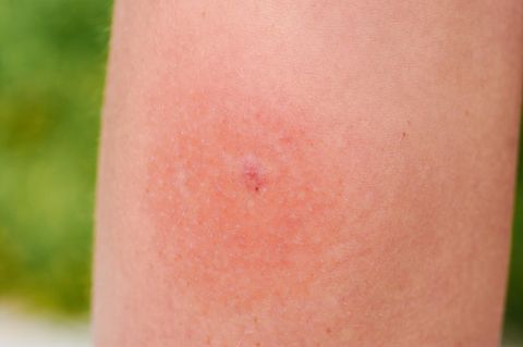 Ein geröteter Insektenstich