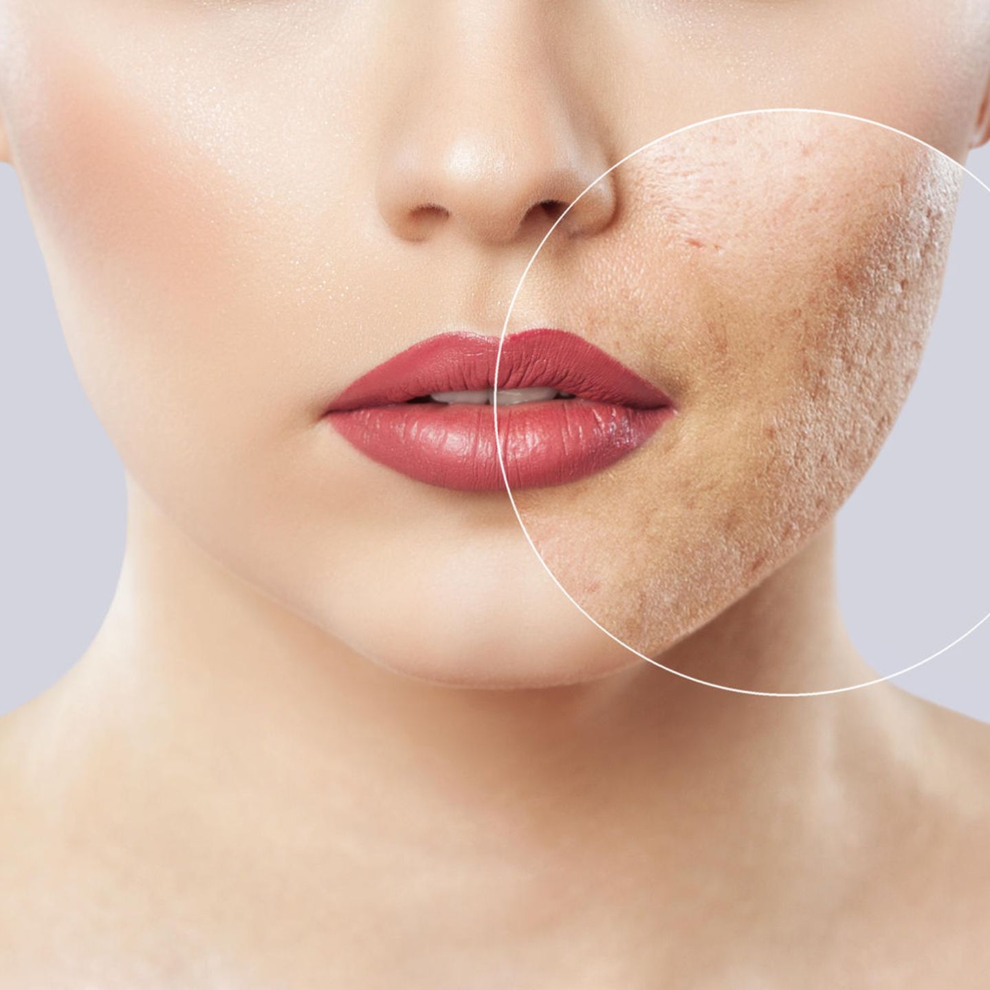 Mitesser entfernen: So wird die Haut porenrein | STERN.de