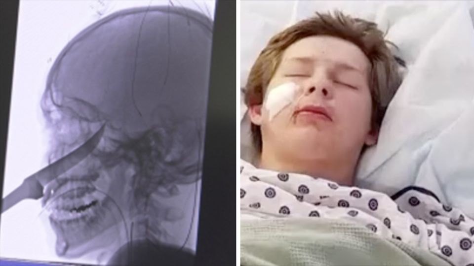 Links zeigt ein Röntgenbild, wie tief das Messer im Kopf steckte, rechts zeigt ein Foto einen Jungen im Krankenhausbett