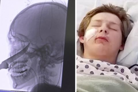 Links zeigt ein Röntgenbild, wie tief das Messer im Kopf steckte, rechts zeigt ein Foto einen Jungen im Krankenhausbett