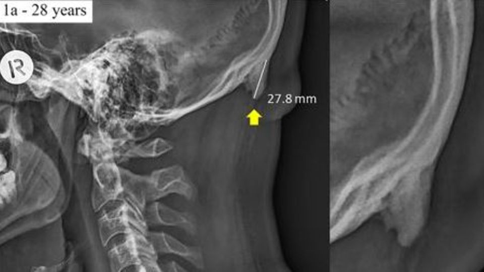 Das Röntgenbild eines 28-jährigen Mannes - der Pfeil zeigt auf einen knöchernen Vorsprung am Hinterkopf