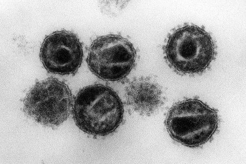 Der Aids-Erreger HIV als elektronenmikrospkopische Aufnahme