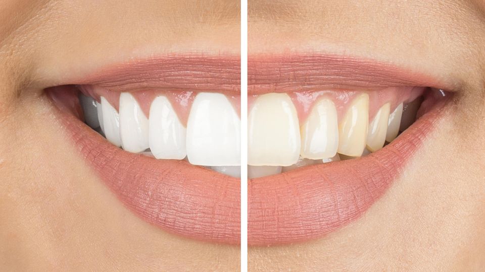 Es gibt verschiedene Methoden, die Zähne aufzuhellen