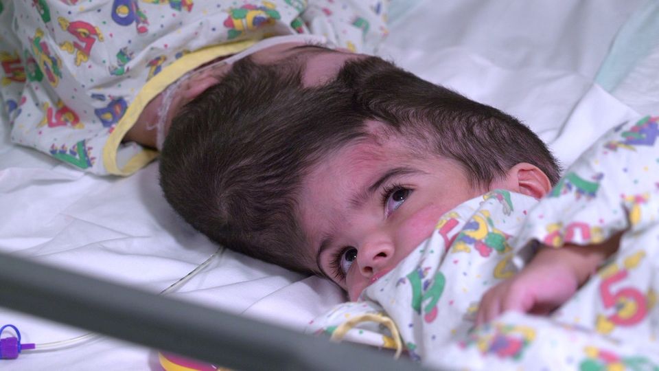Safa und Marwa: Ärzte trennen siamesische Zwillingsmädchen Siamesische Zwillinge getrennt: Safa und Marwa vor der Operation
