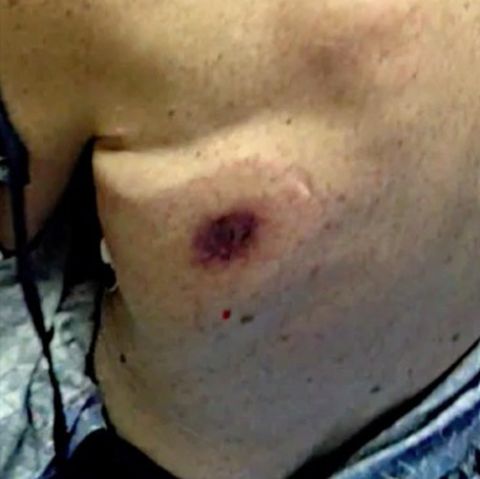 "Fleischfressende Bakterien": Mann stirbt nach Bad im Meer