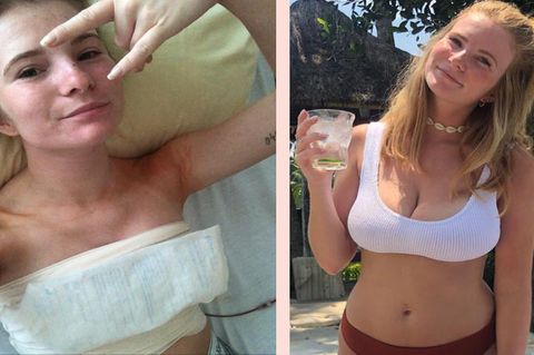 Brustverkleinerung Vorher / Nachher