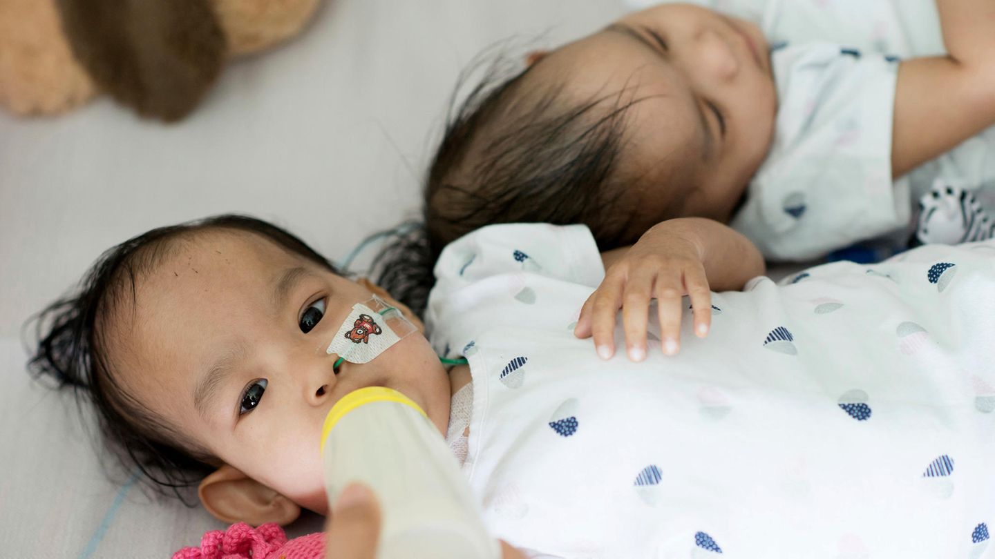 Die siamesischen Zwillingsmädchen Nima und Dawa nach ihrer erfolgreichen Trennungsoperation