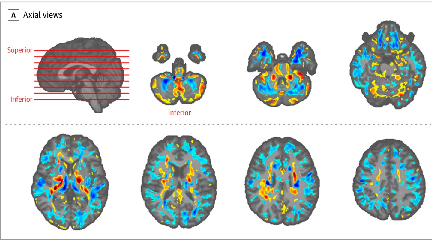 Hirnscans