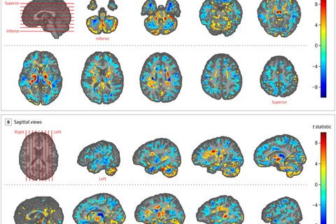 Hirnscans