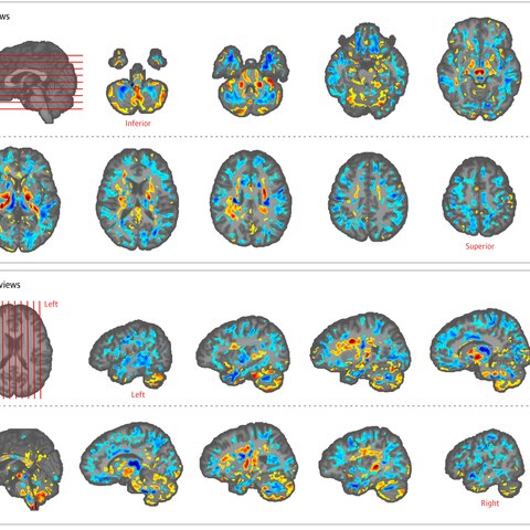 Hirnscans