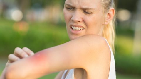 Verärgerte junge Frau kratzt ihren Arm von einem Mückenstich