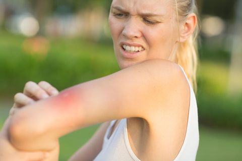 Verärgerte junge Frau kratzt ihren Arm von einem Mückenstich