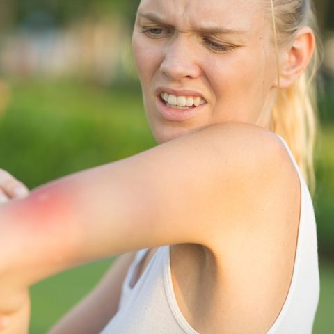 Verärgerte junge Frau kratzt ihren Arm von einem Mückenstich