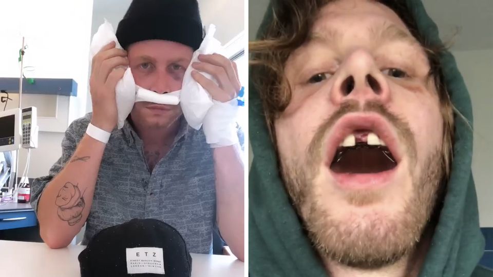Malte Zierden teilt das Abenteuer seiner Gaumenspaltung auf Instagram