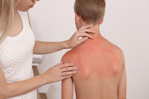Besonders Kinder neigen zur Sonnenallergie