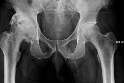 Urology Case Reports 2019: Penis Ossifikation auf Röntgenbild