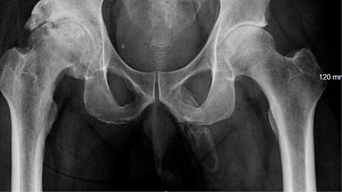 Urology Case Reports 2019: Penis Ossifikation auf Röntgenbild