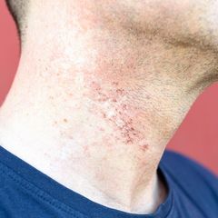 Rasurbrand beim Mann