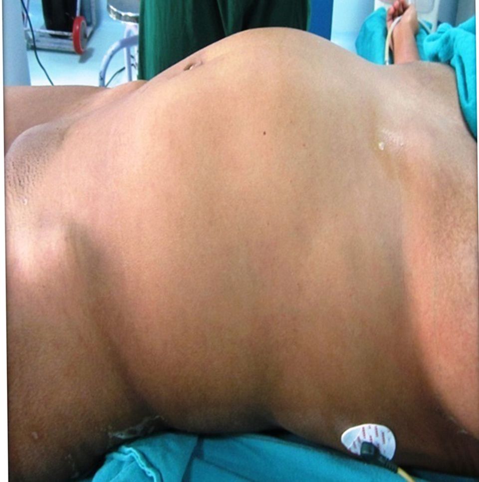 Foetus in foeto: Der Bauch der Frau ist stark angeschwollen