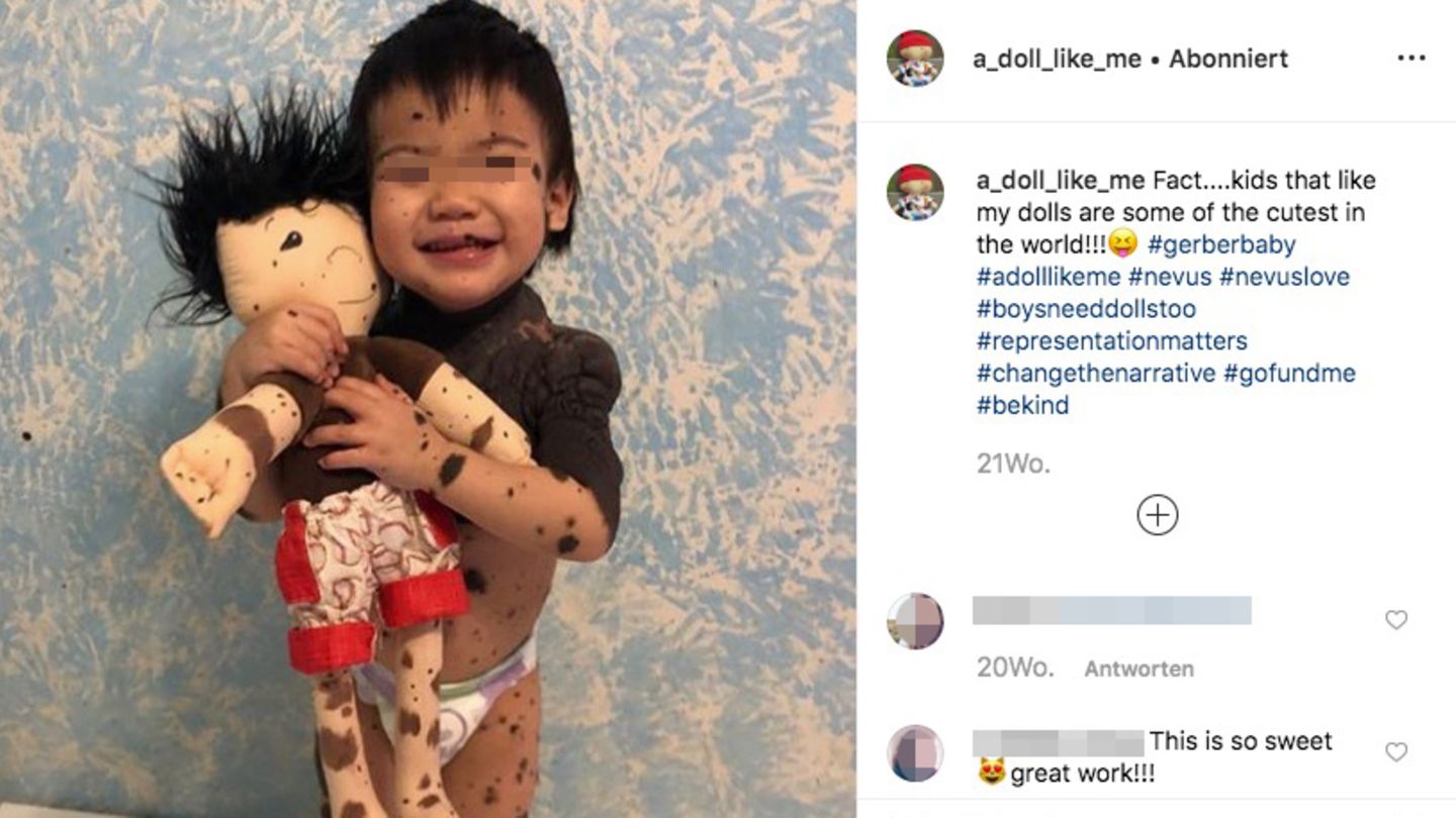 Ein Junge mit vielen Muttermalen mit seiner Puppe