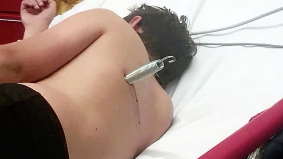 Ein Junge auf einem Krankenbett mit Metallstück im Rücken Ein Junge auf einem Krankenbett mit Metallstück im Rücken