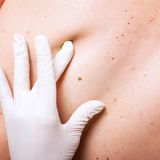 Früherkennung von Hautkrebs: Ein Dermatologe untersucht einen Leberfleck