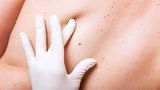 Früherkennung von Hautkrebs: Ein Dermatologe untersucht einen Leberfleck