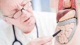 Früherkennung von Darmkrebs: Ein Arzt zeigt auf ein Modell des menschlichen Darms