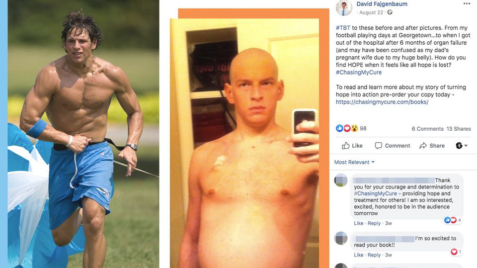 David Fajgenbaum links gesund beim Sport, rechts mit aufgeblähtem Bauch und Glatze während der Chemotherapie