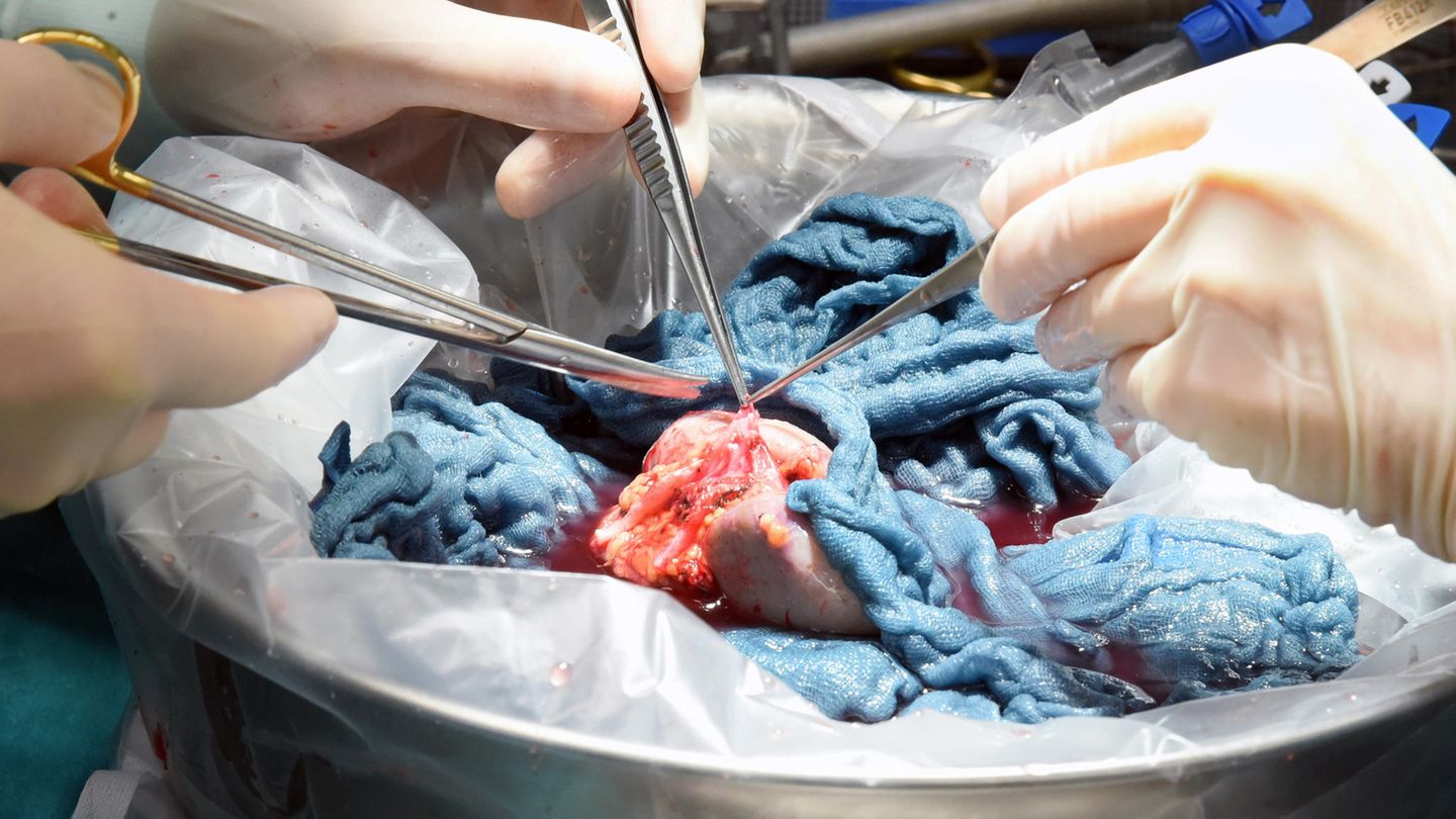 Organspende: Eine Spenderniere wird von Ärzten für die Transplantation vorbereitet