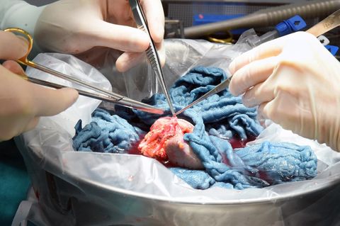 Organspende: Eine Spenderniere wird von Ärzten für die Transplantation vorbereitet