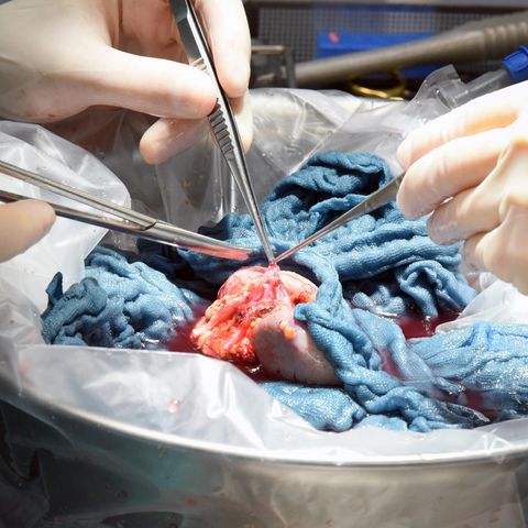 Organspende: Eine Spenderniere wird von Ärzten für die Transplantation vorbereitet