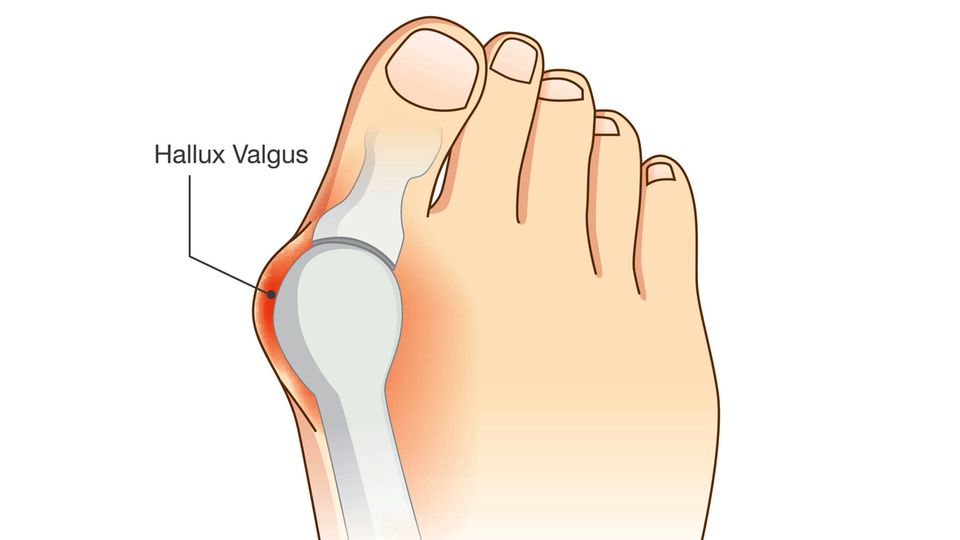 Hallux valgus