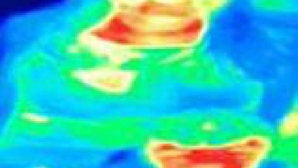 Das Wärmebild von Bal Hill zeigt ihre Erkrankung