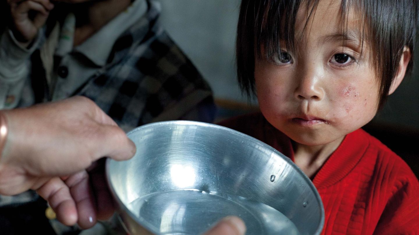 Kim Nam Hui (4 Jahre) ist stark mangel- und unterernährt Kim Nam Hui (4 Jahre) ist stark mangel- und unterernährt