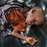 Adam ist fünf Jahre alt und stark unterernährt