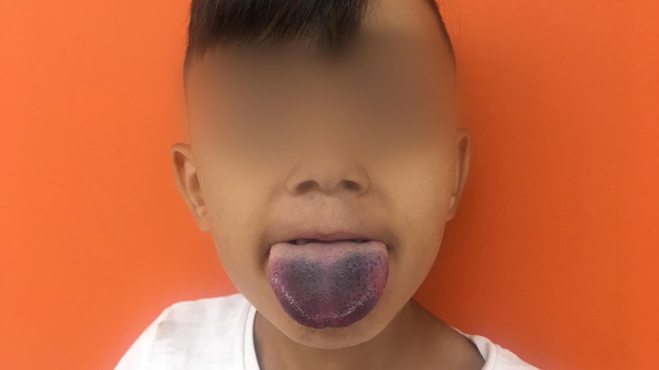Junge steckt mit Zunge in Flasche fest - Arzt befreit ihn mit einfachem Trick Zunge in Flasche: Die Zunge des Jungen mit einem Bluterguss