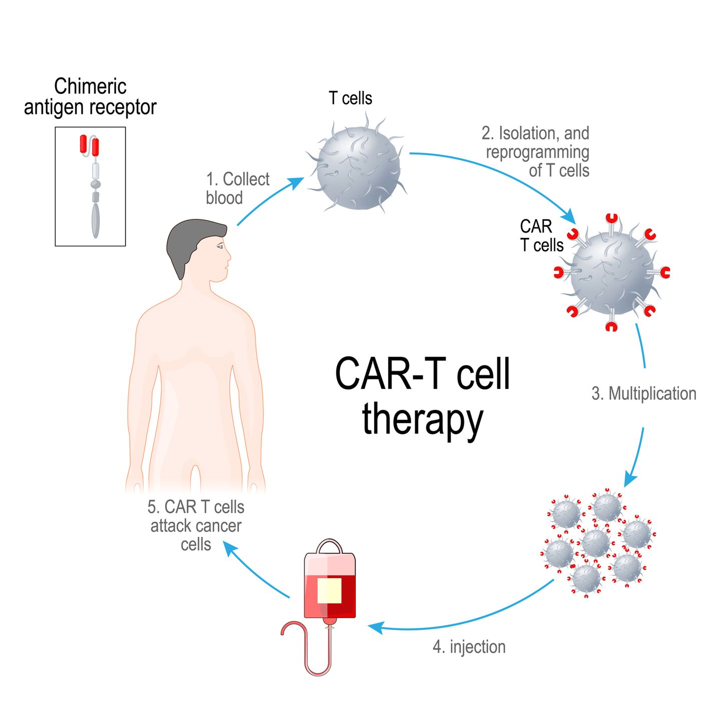 Erfolgreiche Krebsbekämpfung durch die CAR-T-Zellen-Therapie Erfolgreiche Krebsbekämpfung durch die CAR-T-Zellen-Therapie