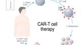 Erfolgreiche Krebsbekämpfung durch die CAR-T-Zellen-Therapie