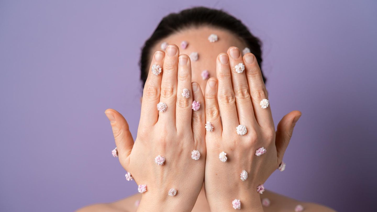 What helps against pimples? How to treat blemishes