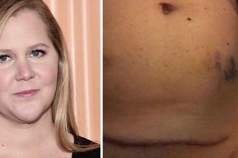 US-Komikerin : Amy Schumer postet ein Foto ihres Bauches mit blauen Flecken und stößt eine ernste Diskussion an