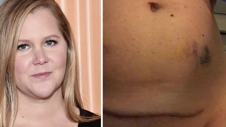 US-Komikerin : Amy Schumer postet ein Foto ihres Bauches mit blauen Flecken und stößt eine ernste Diskussion an