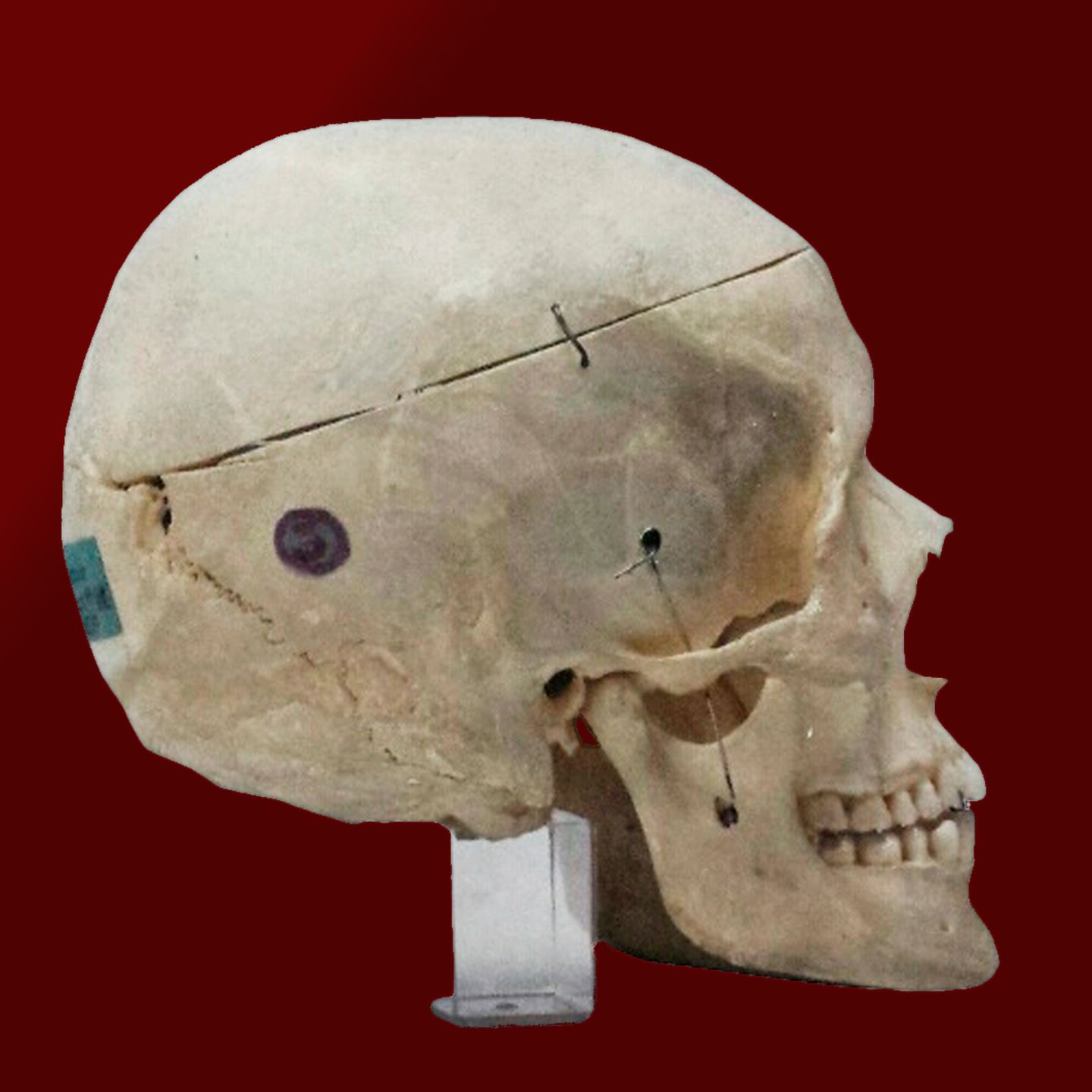 Nitribitts Schädel