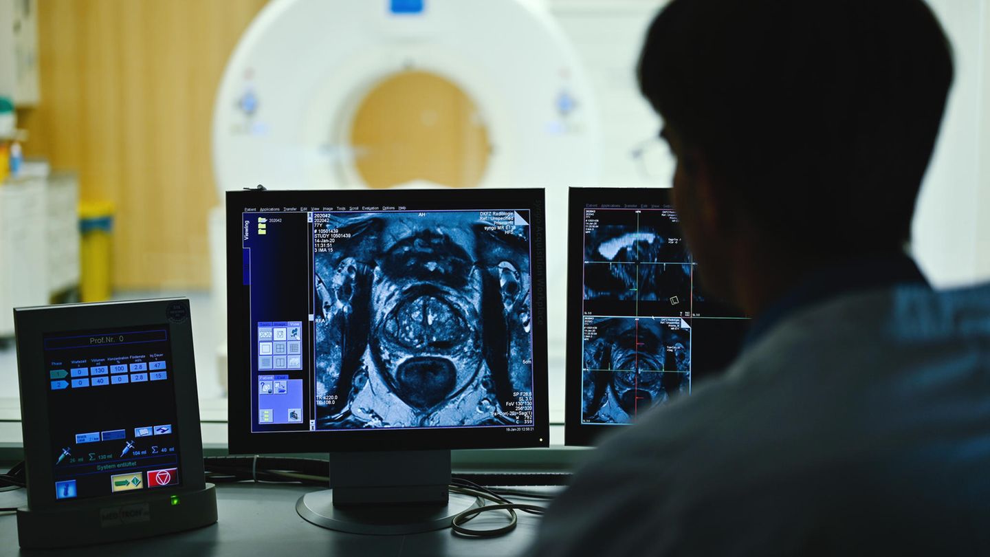Auf einem Monitor im Kontrollraum des Deutschen Krebsforschungszentrum erscheint das Querschnittsbild einer Prostata