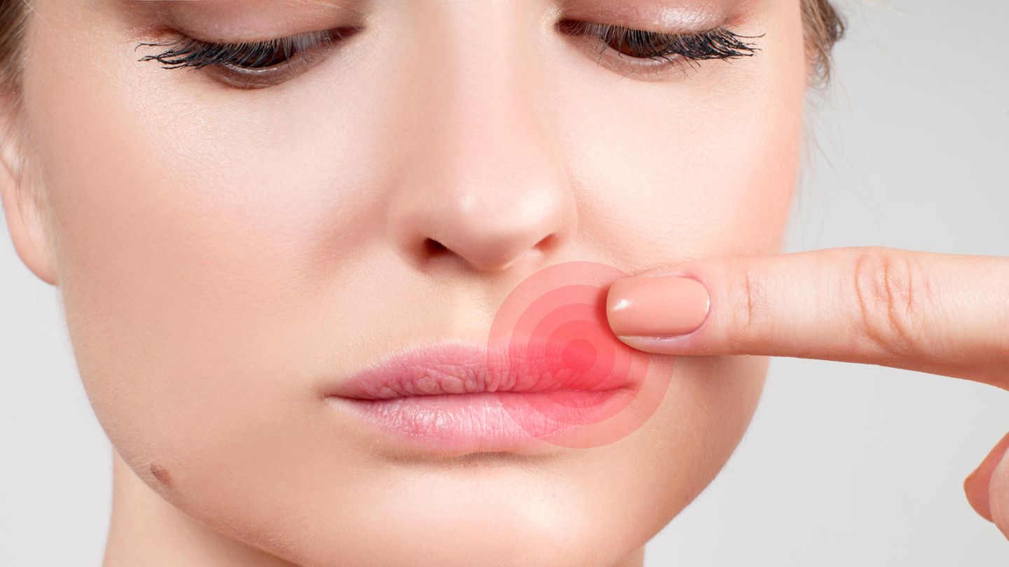 Virusinfektion: Was hilft gegen Herpes? So behandeln Sie die Lippenbläschen richtig