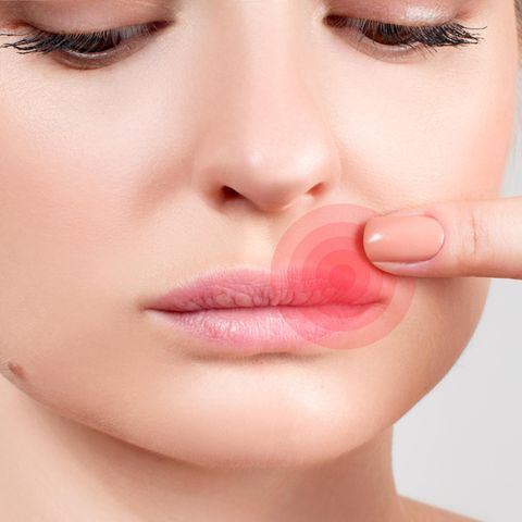 Was hilft gegen Herpes?