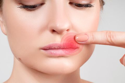 Was hilft gegen Herpes?